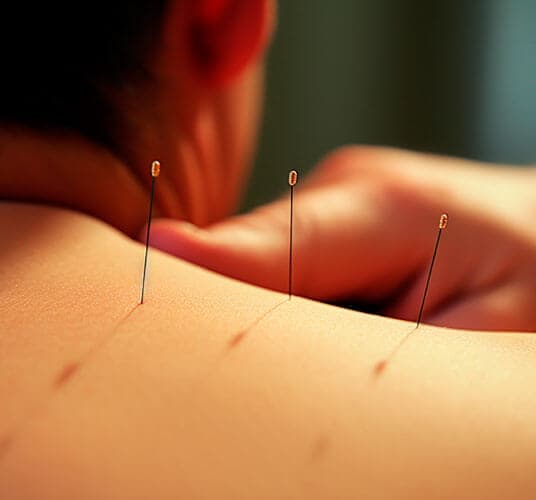 Acupuncture